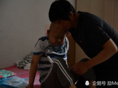 68岁男子患巨人症：手脚二次发育，揭秘罕见病症背后的科学之谜